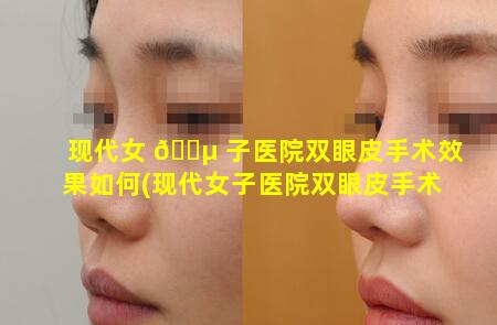 现代女 🌵 子医院双眼皮手术效果如何(现代女子医院双眼皮手术效果如何 🐞 样)